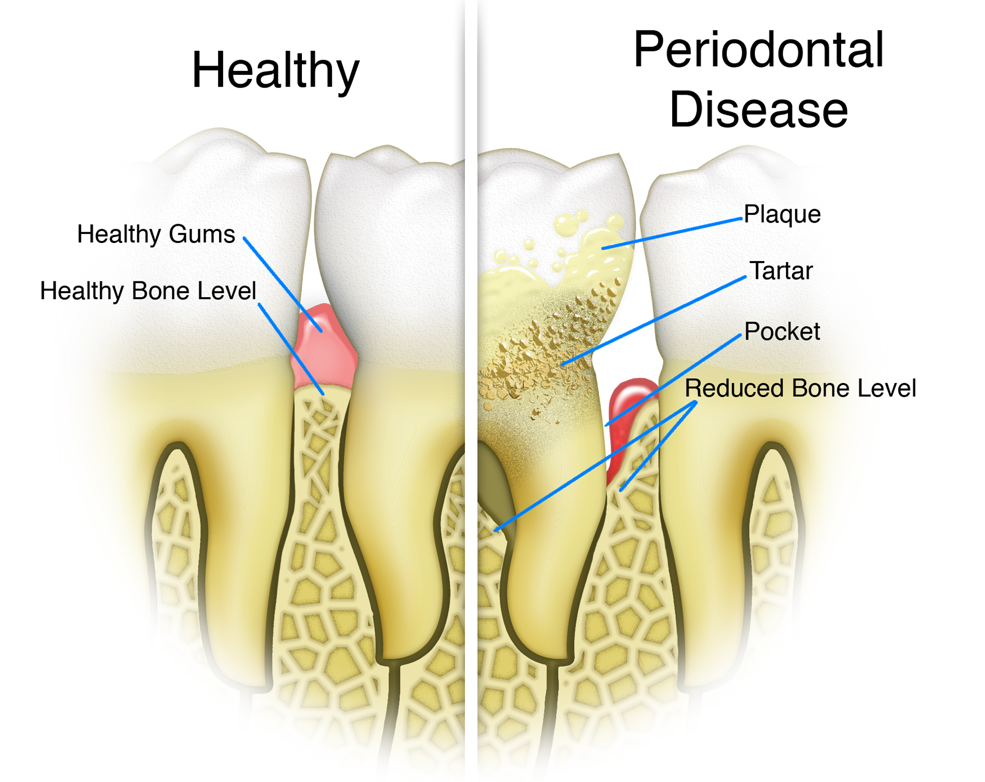 Periodontal Disease: The Painless Path To Tooth Loss