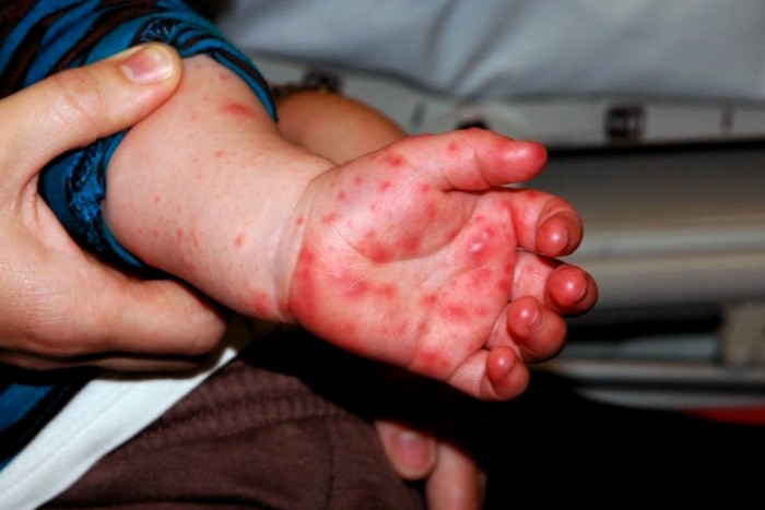 Foot Mouth And Hand Virus 80