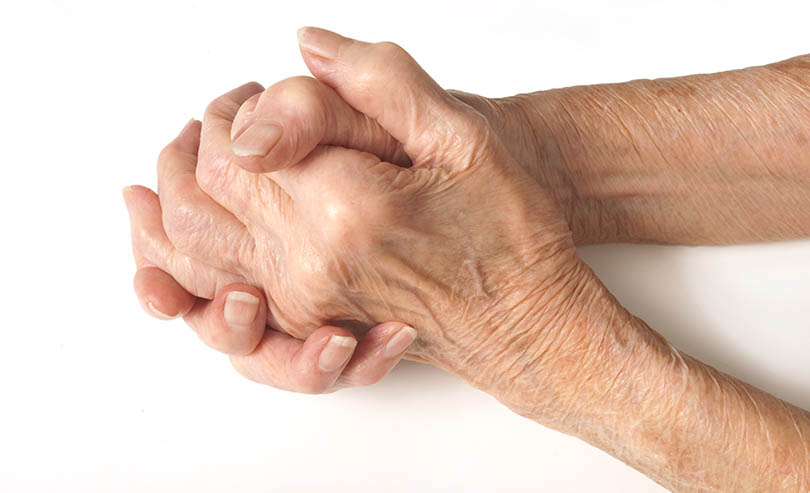 How to Recognize the Signs of Arthritis