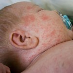 Childhood Skin Rashes
