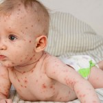 chicken pox dieases