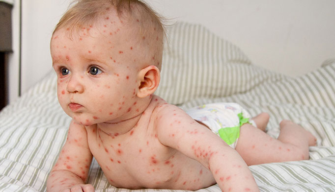 chicken pox dieases