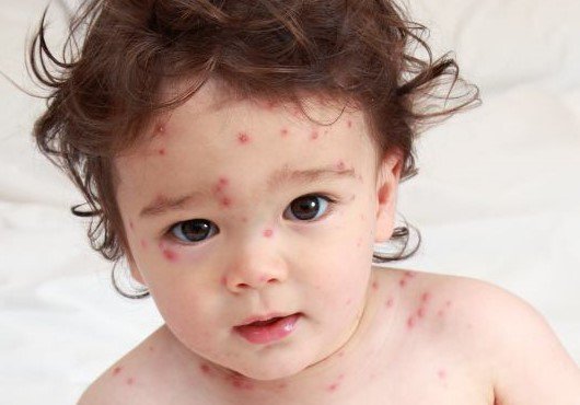 chickenpox