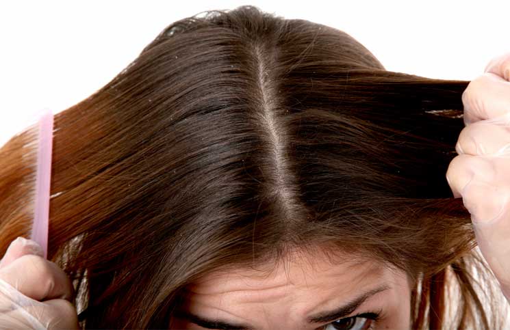 Tips and Tricks to Remove Dandruff Fast