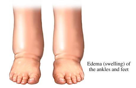 edema