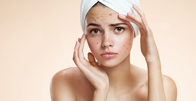 5 Things You should Stop Doing if You have Acne