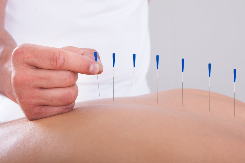 Common Facts about Acupuncture