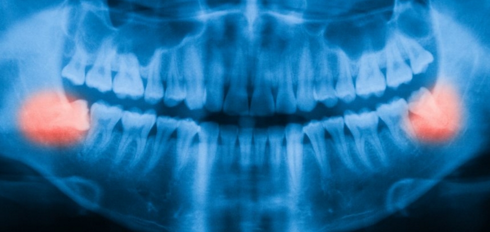 5 Important Questions about Wisdom Teeth Removal Answered