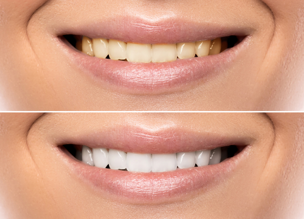 5 Ways to Whiten Your Teeth Naturally