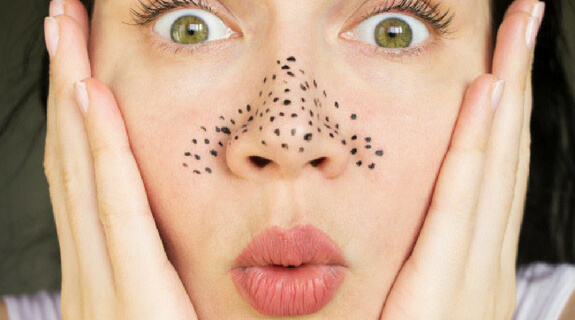 6 Effective Ways to Remove Blackheads