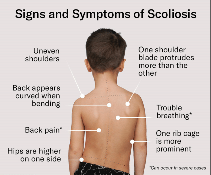 Scoliosis in Children