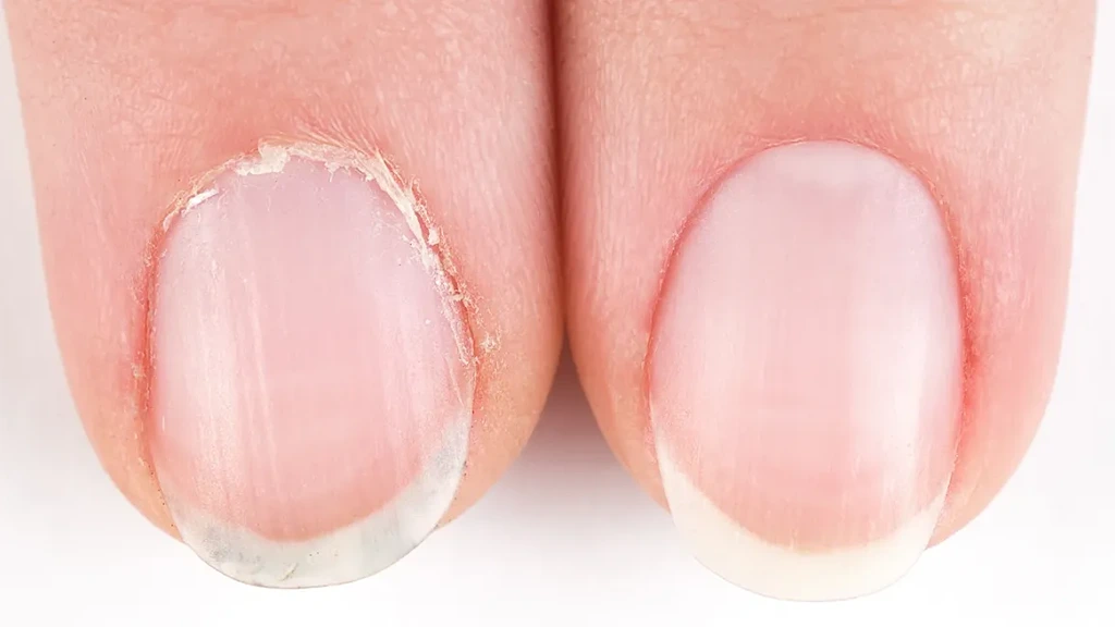 Ignoring Nail and Cuticle Care